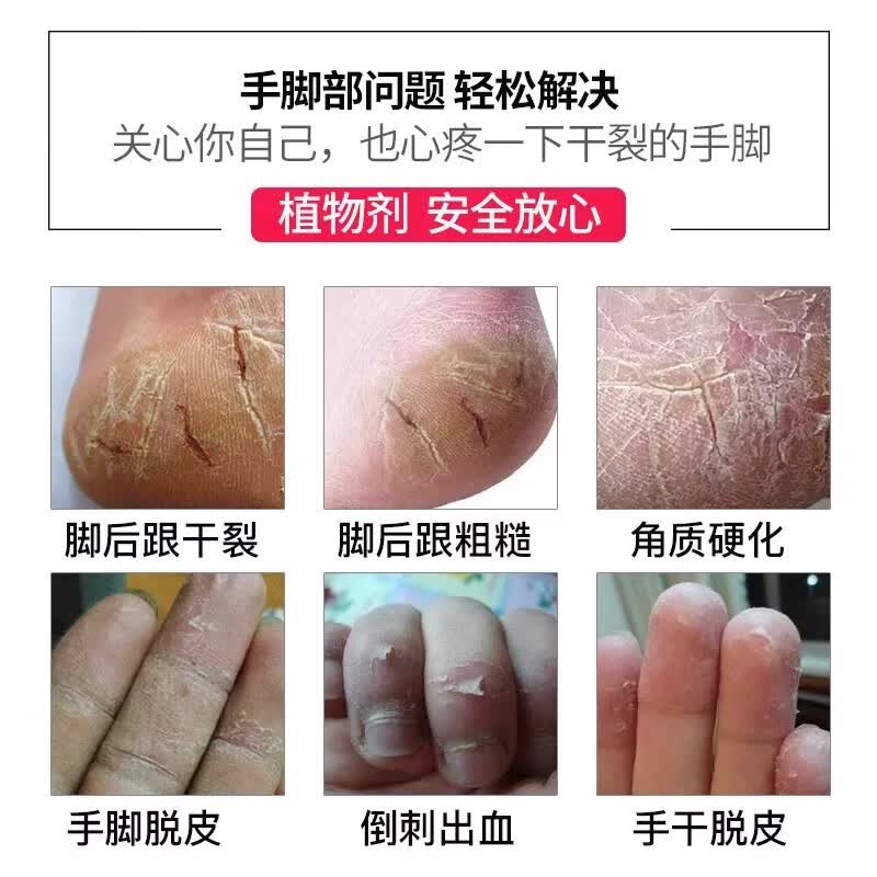 夫洁美宝脚后跟干裂起死皮修复真菌感染手足脱皮皲裂止痒保湿滋润霜脚裂膏 发五盒【深层巩固装】