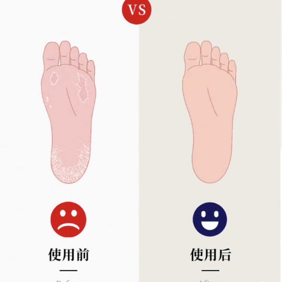 华佗脚气王止痒水泡脚臭脚气烂脚去白皮真菌感染草本抑菌乳膏 艮除装【买三送四】七盒