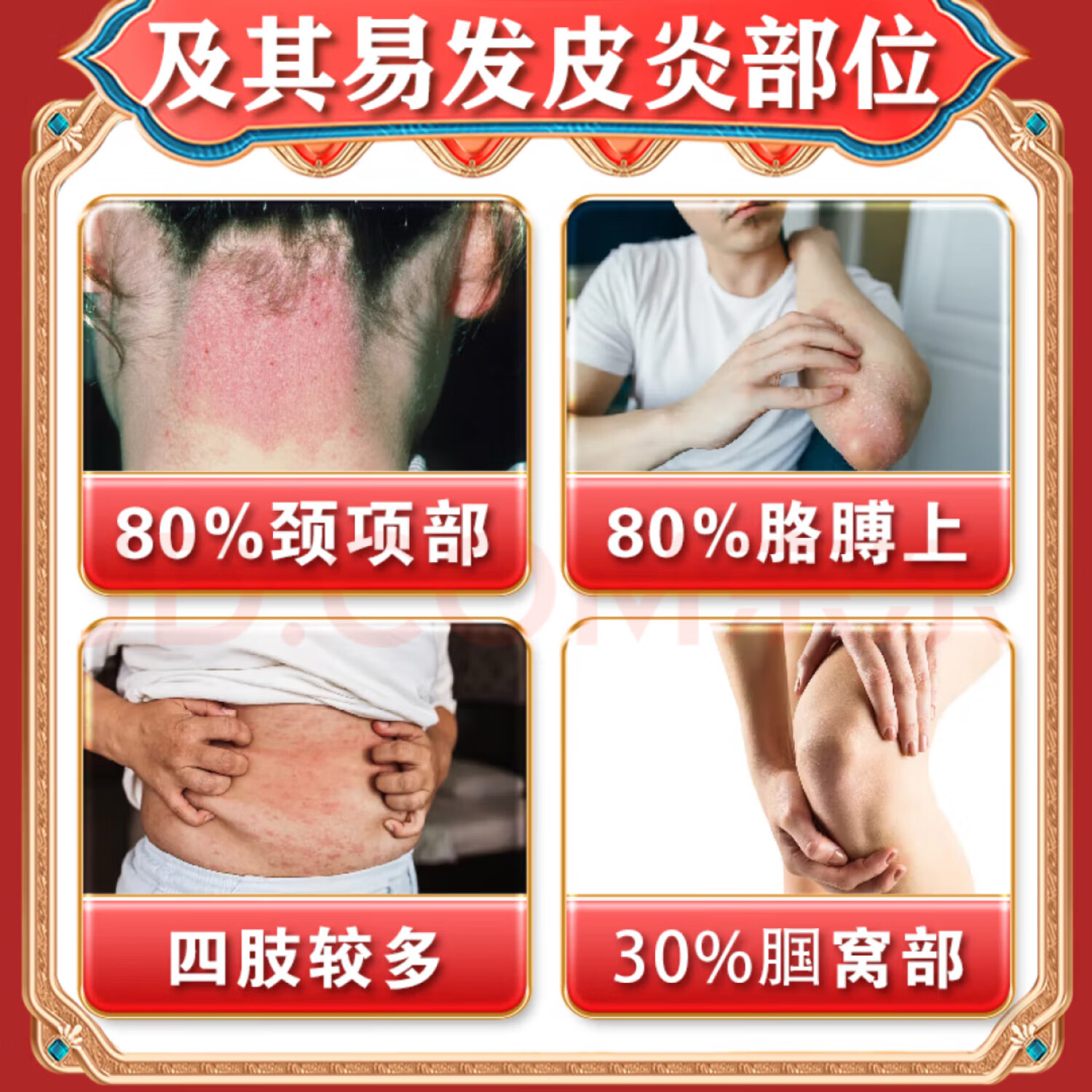 金志龙脖子上长片癣痒药膏红痒刺挠颈部上起红疙瘩过敏神经性皮肤止痒膏 发五盒【买三送二深层巩固装】