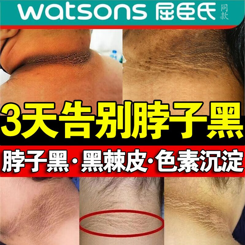 脖子黑色素去除黑棘皮病治脖子腋下黑黑的去淡化黑印药美神器膏白 60g