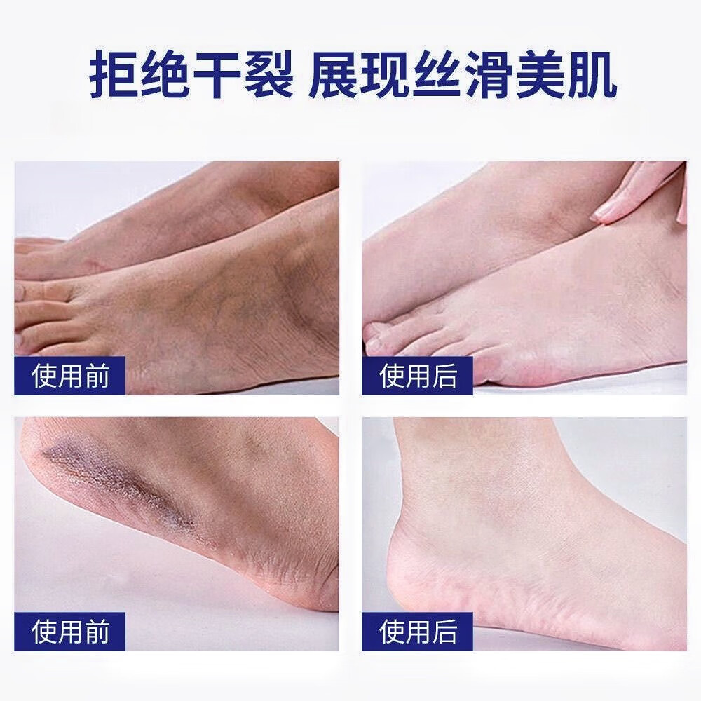 夫洁美宝脚后跟干裂起死皮修复真菌感染手足脱皮皲裂止痒保湿滋润霜脚裂膏 发五盒【深层巩固装】