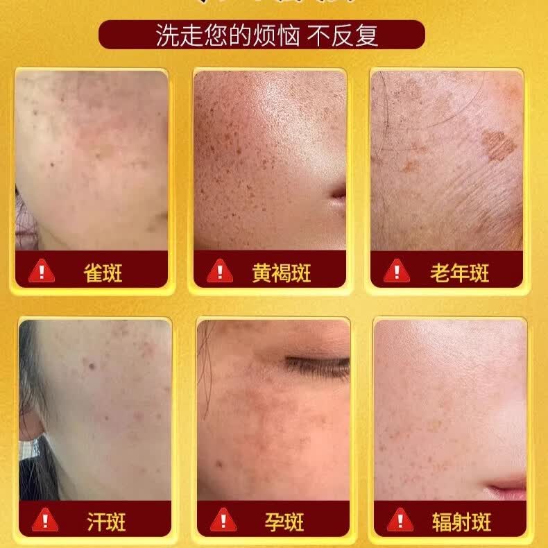 示博士【强力祛斑】红花祛斑洁面皂淡斑老年斑晒斑黑色素黄褐斑洗面皂 买三送二-【缓解小斑】*周期装
