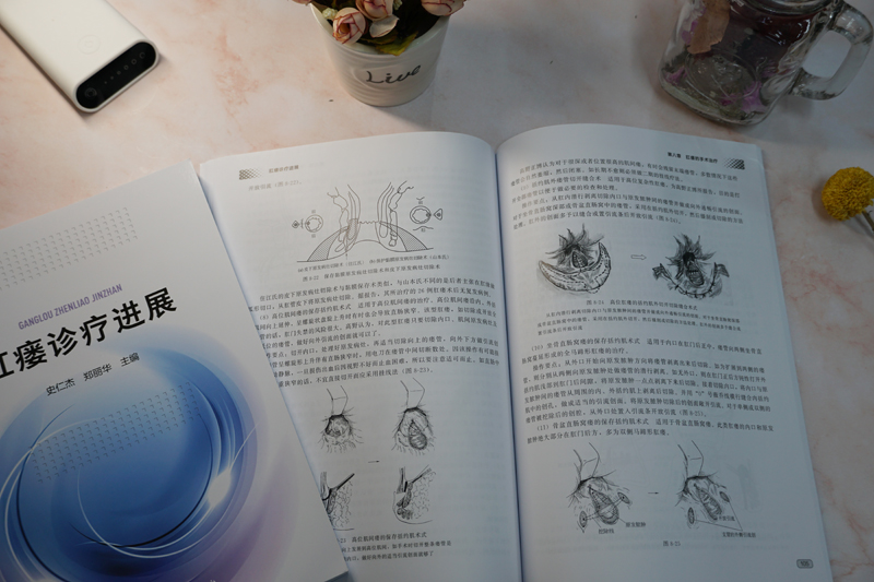 肛瘘诊疗进展