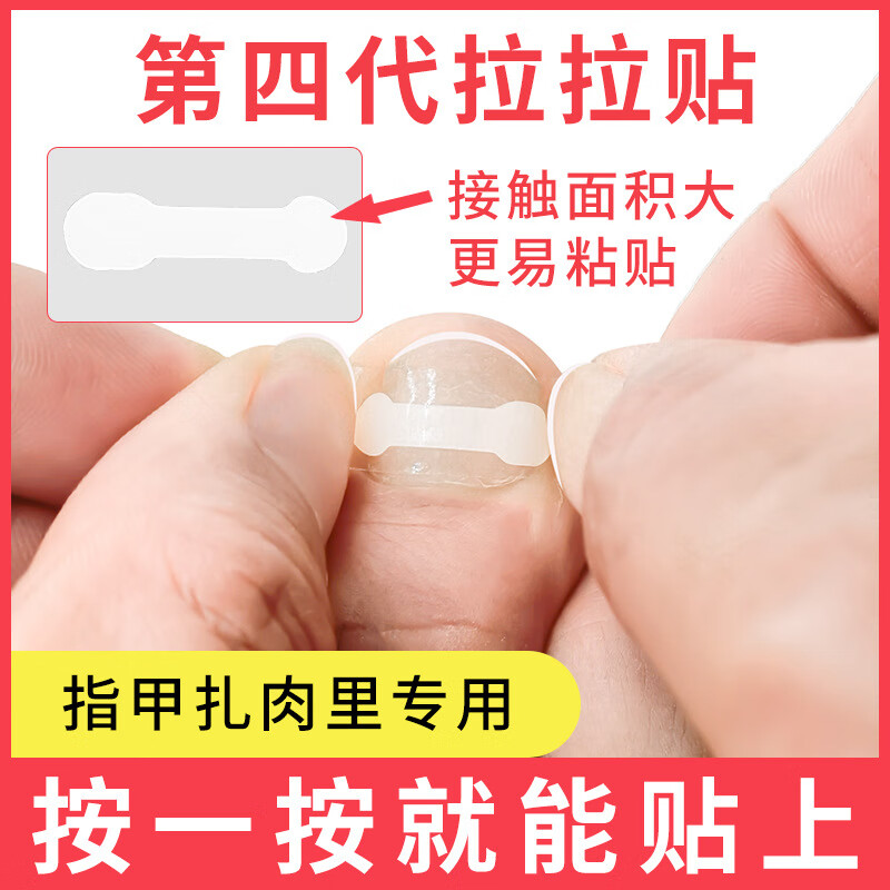 正甲貼腳趾甲專用甲溝炎矯正器嵌甲矯正器貼片指甲長肉里腳器神 10個貼+10張速粘貼+膠水