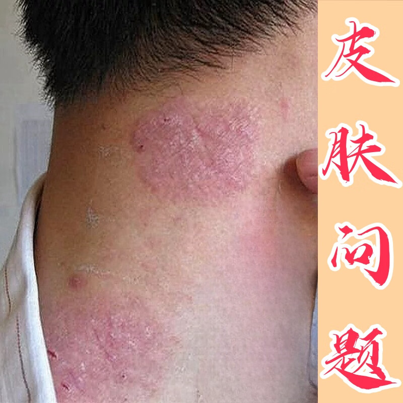 金志龙脖子上长片癣痒药膏红痒刺挠颈部上起红疙瘩过敏神经性皮肤止痒膏 发五盒【买三送二深层巩固装】 京东折扣/优惠券