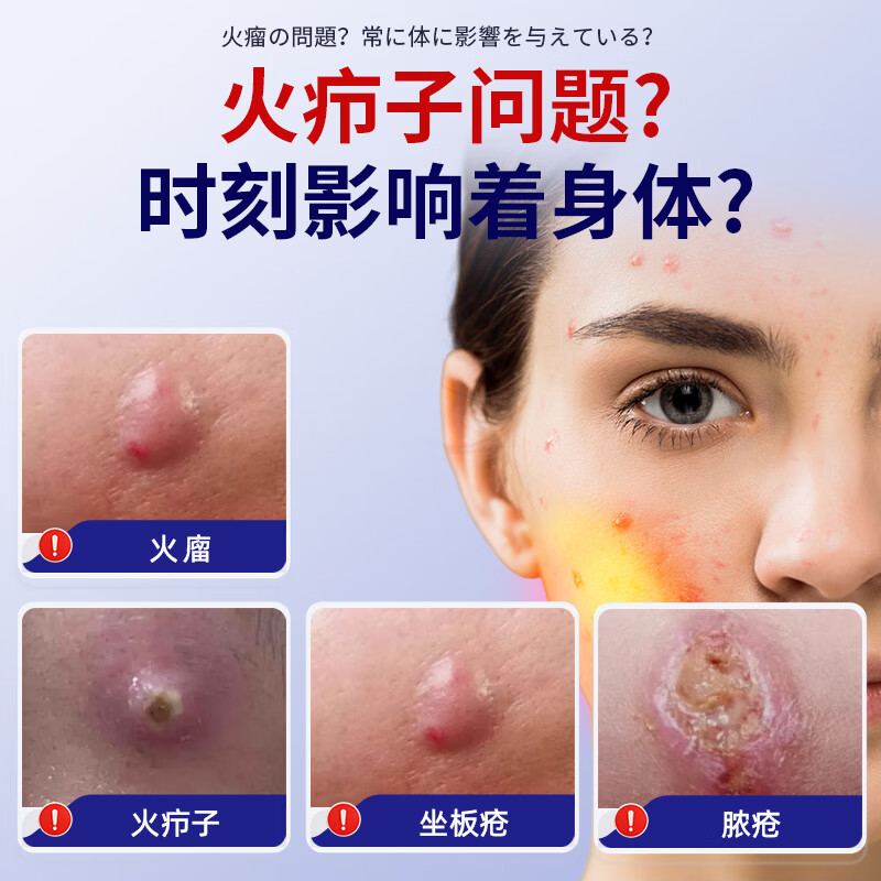 制药火疖子专用软膏硬块疙瘩火疖子拔毒拔脓敷料药膏贴治疗坐板疮屁股