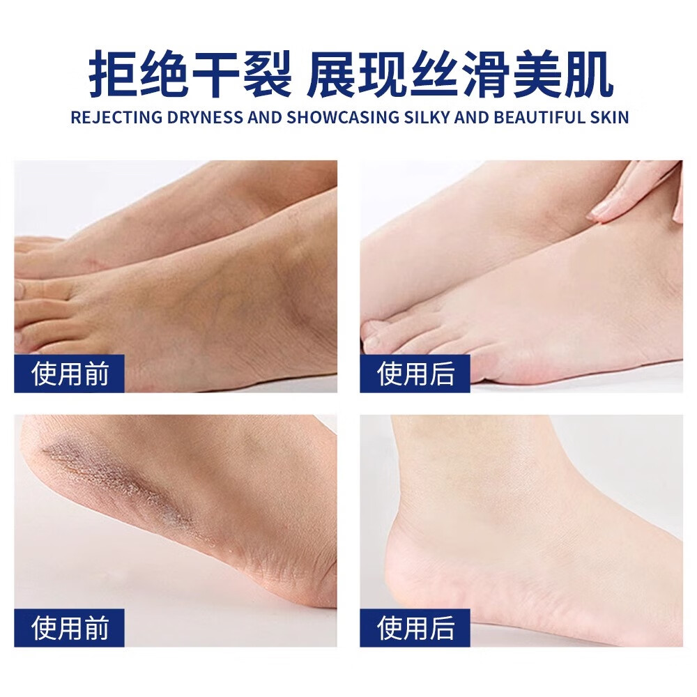 使密康药店同款】手足脱皮抑菌膏皲裂脚裂膏脚后跟正干裂品京开裂去死皮 5支装【巩固持续日常护理】