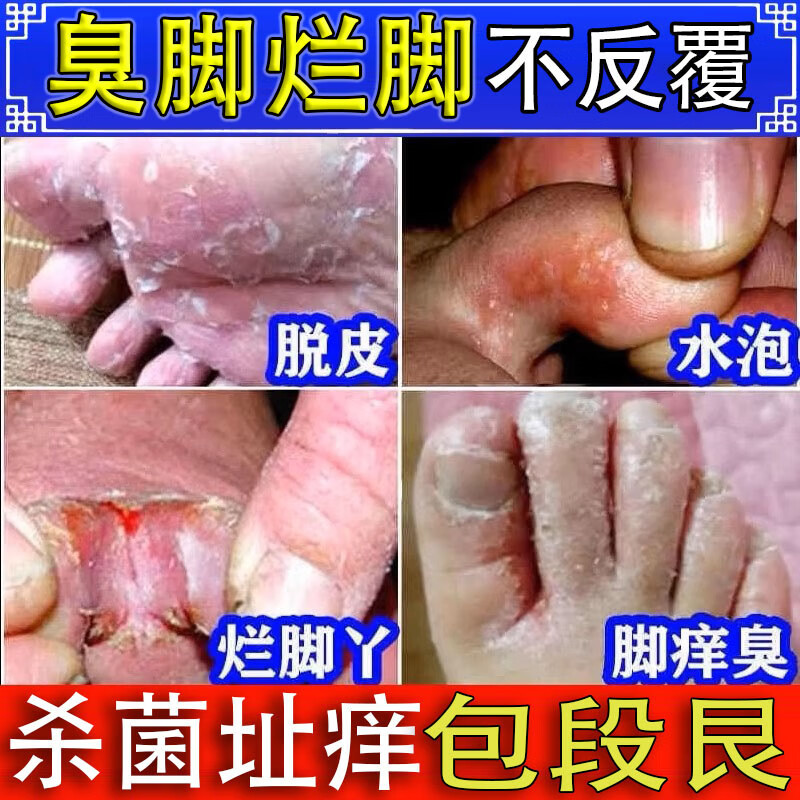 华佗脚气王止痒水泡脚臭脚气烂脚去白皮真菌感染草本抑菌乳膏 艮除装【买三送四】七盒