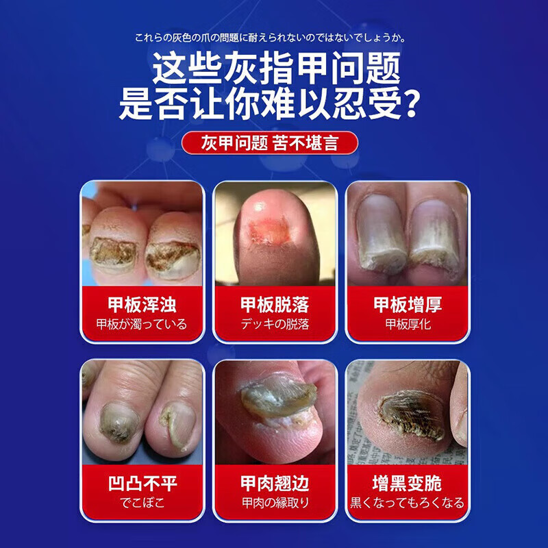 久研制药日本灰指甲特傚效药第1名正品增厚发黄变空中沟草炎药进口抑菌液 一瓶【体验装】