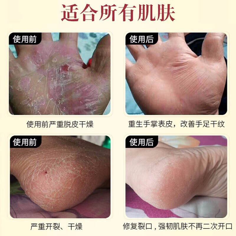 熙婷马油手足膏护足霜脚后跟干裂膏脱皮干裂手足皲裂膏防冻裂滋润霜 马油手足修护霜1盒