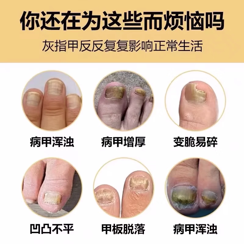 北京同仁堂灰指甲泡脚药包真菌感染甲床分层增厚损伤指甲坏甲杀菌脚臭足浴包 单盒【体验装 30包/盒】