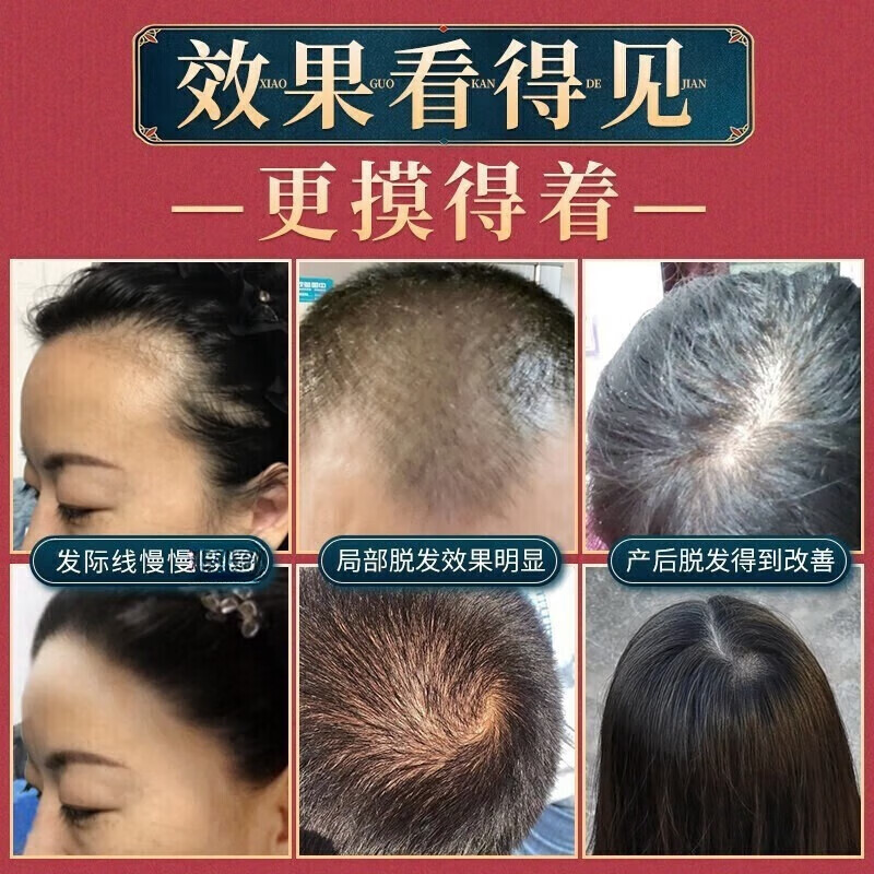 南京同仁堂防脱育发生姜洗发水露秃顶脱发根控油强劲养发露男女士固发品牌 1瓶装【南京同仁堂品牌防脱固发】400ml 【有防伪标识买的放心】