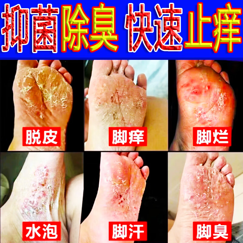 华佗脚气王止痒水泡脚臭脚气烂脚去白皮真菌感染草本抑菌乳膏 艮除装【买三送四】七盒
