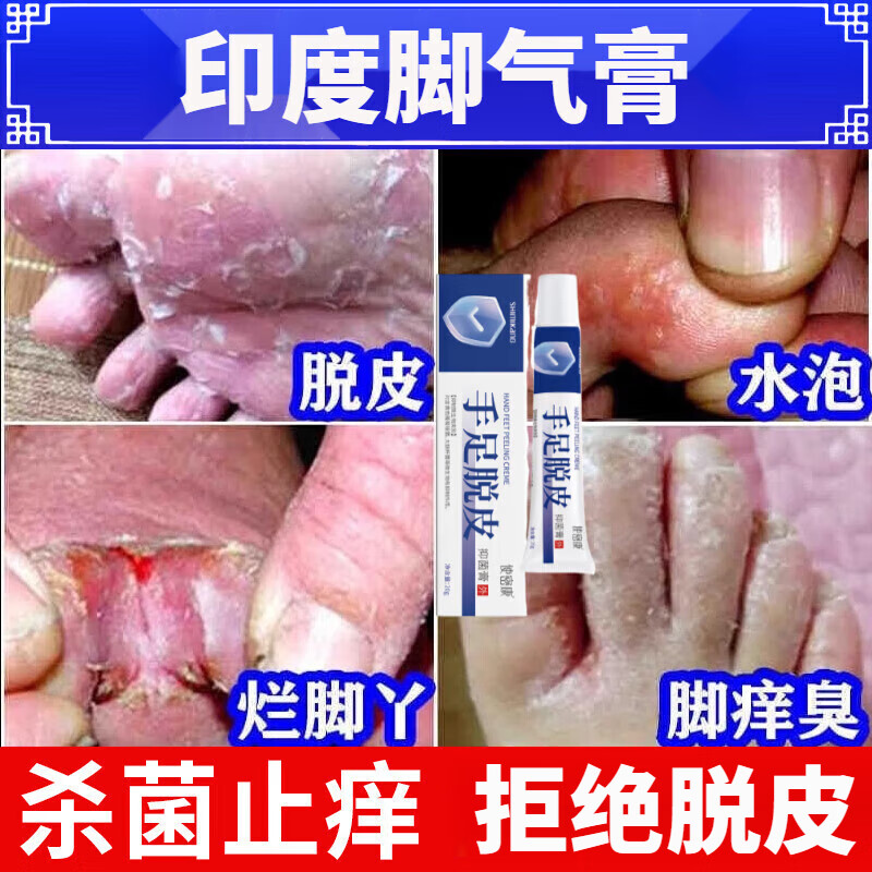 印度脚气膏止痒脚臭清新治脱皮水泡烂脚丫脚痒脚气膏正品 一盒装