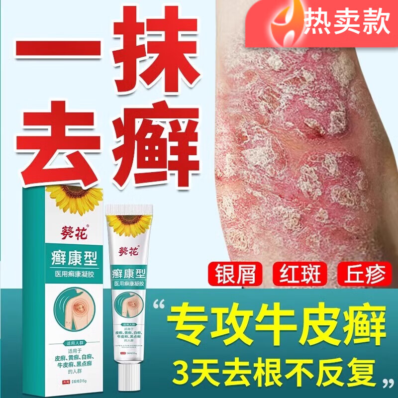 祥醫(yī)堂牛皮蘚醫(yī)用凝膠牛皮癬膏牛皮癬i藥膏 真菌止癢 抑菌 皮膚銀屑病真 5盒鞏固裝拒絕反復