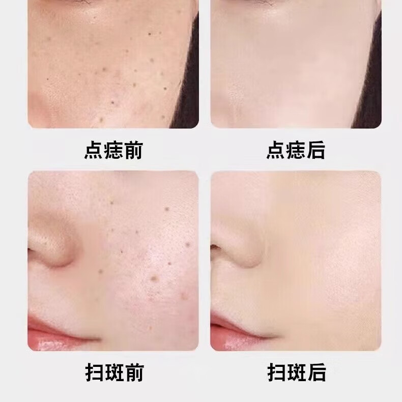 祥醫堂去疣点痣激光笔【可家用美容院同款】扫斑专用医用仪器蓝光修护神器除扁平丝状私处尖锐湿肉脂肪粒 15档+咪奎乳膏【点疣推荐】