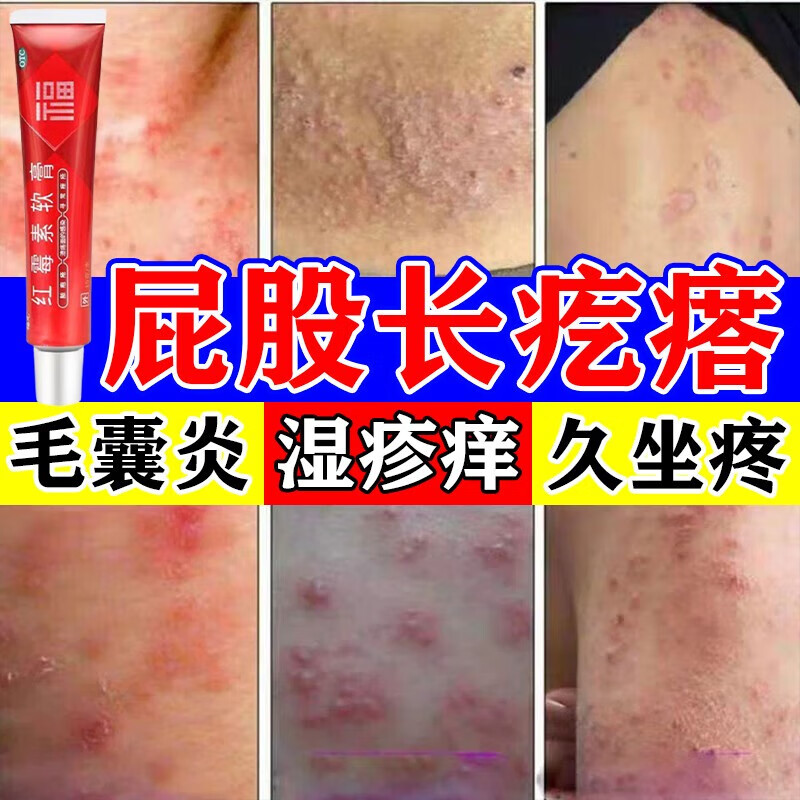 坐板疮屁股长疙瘩久坐长痘痘湿疹痒脓胞疮股癣大腿内侧湿痒红疹皮炎