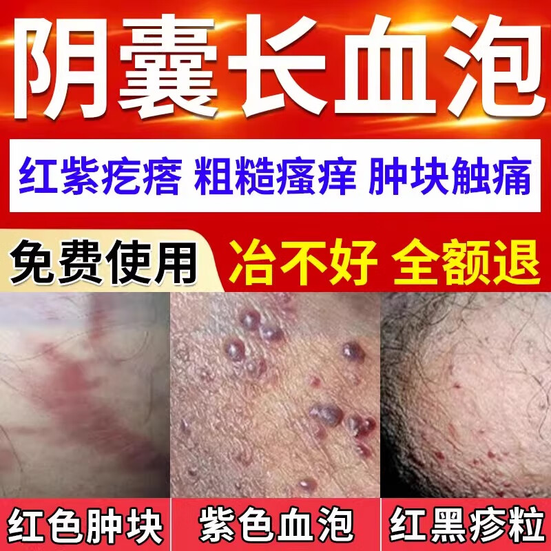 吻音【医用】阴囊血管瘤专用阴囊血管角化瘤血管痣睾丸阴囊红点肿块l6