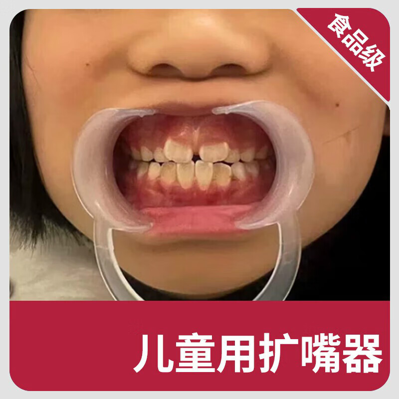 飞鱼跃官儿童专用嘴巴扩张器开口刷牙扩嘴器牙科口腔宝宝扩牙撑嘴幼儿