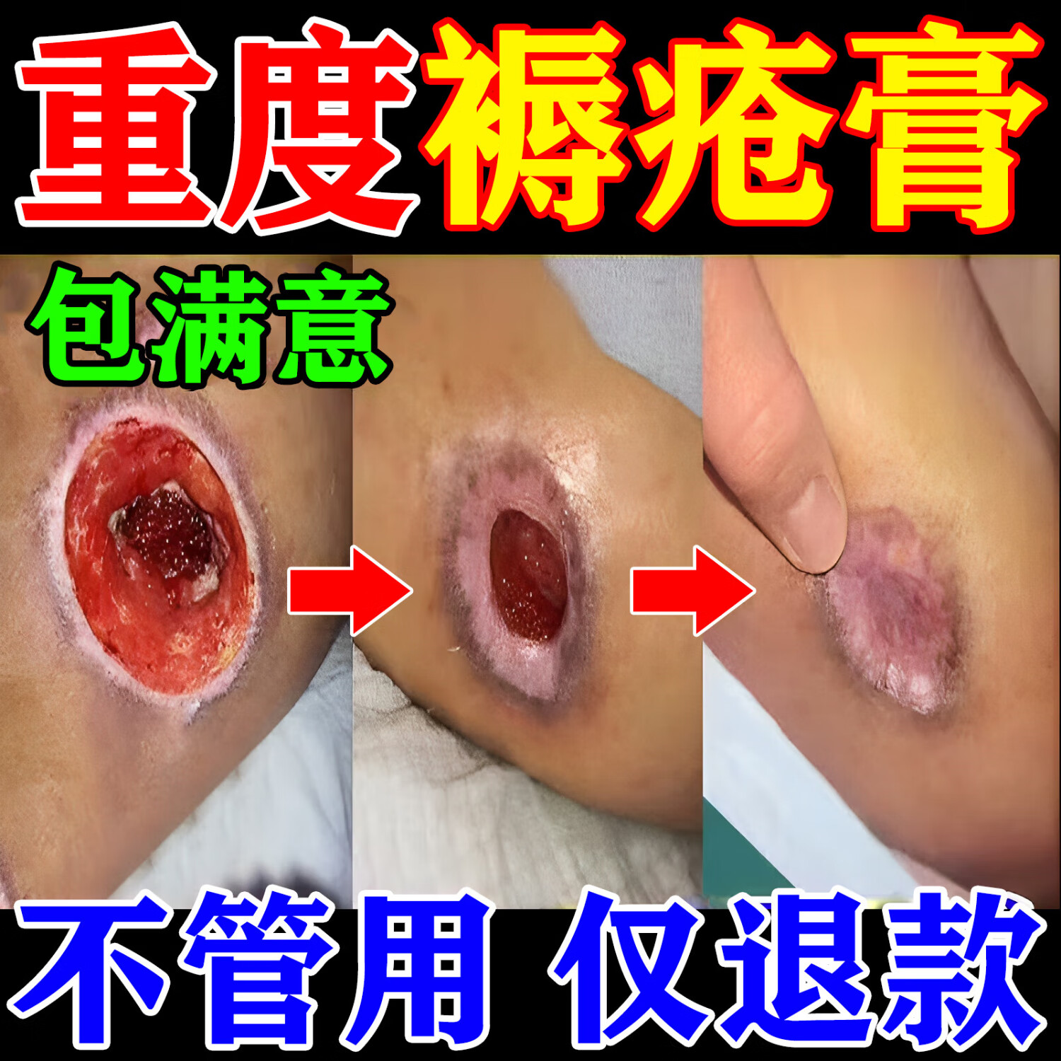 云南白药褥疮膏药压疮皮肤溃烂去i腐生肌膏伤口愈合医用老人臀部外用药贴 特效发货快【买1发3】愈合长肉 褥疮膏特效专用老年人重度褥疮生肌治长期卧床医院专用