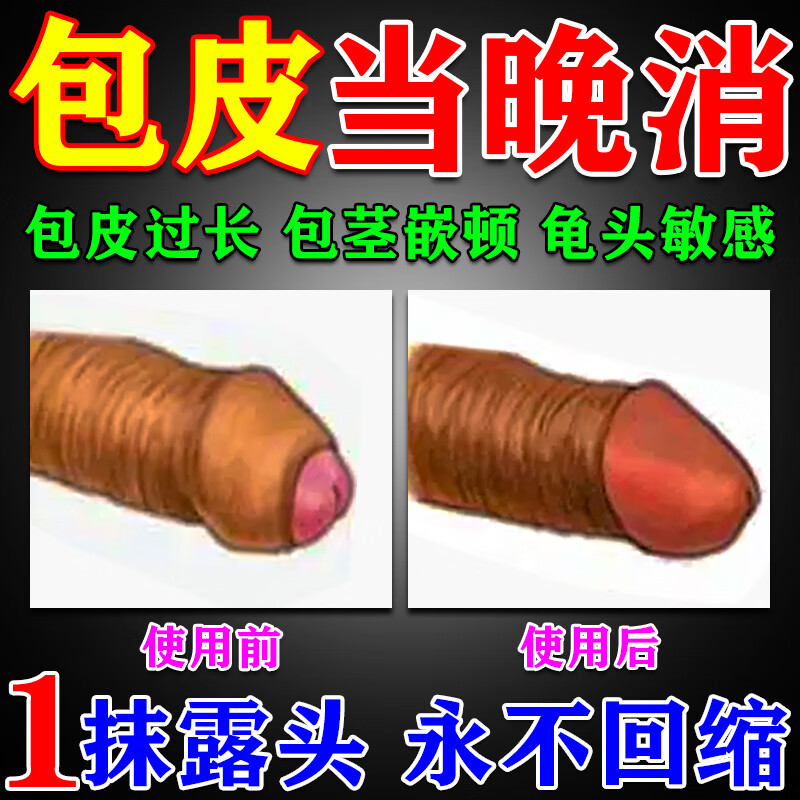 独爱包皮自动切除器包皮收缩液无痛不手术去包皮过长包茎嵌顿专用的药 特效：包皮过长专用【1盒装】