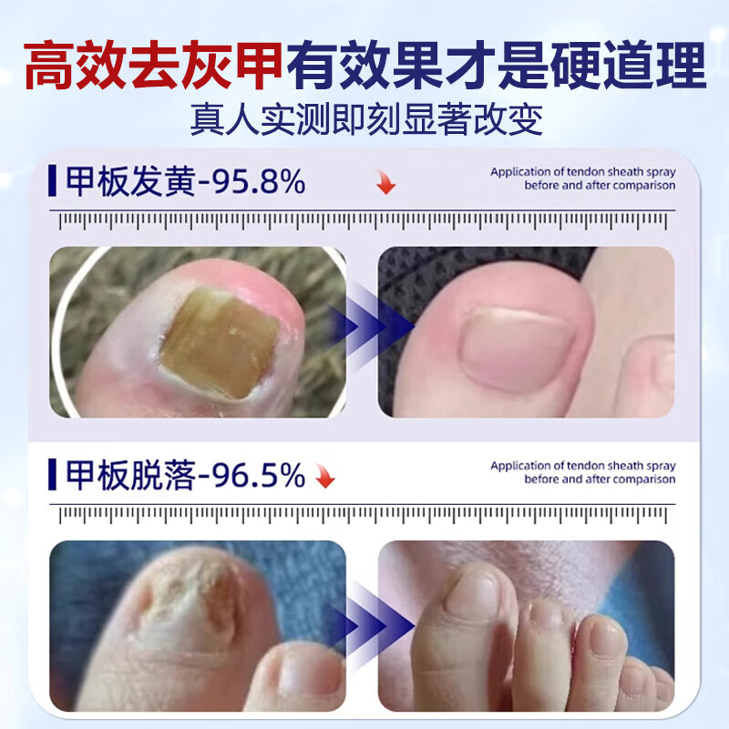 重度灰指甲100%特效专用的药特殊效专用抑菌液灰甲净套装 一盒【特效套装】1-2个灰甲选 灰指甲100%特效专用的药第一名