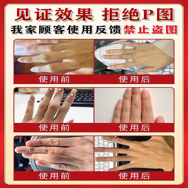 香港透骨膏类风湿性关节炎100%效药风湿膏药风湿关节疼痛专用膏药风湿止痛膏 特效1盒装【泰国透骨膏】 手指疼痛肿胀弯曲困难僵硬变形