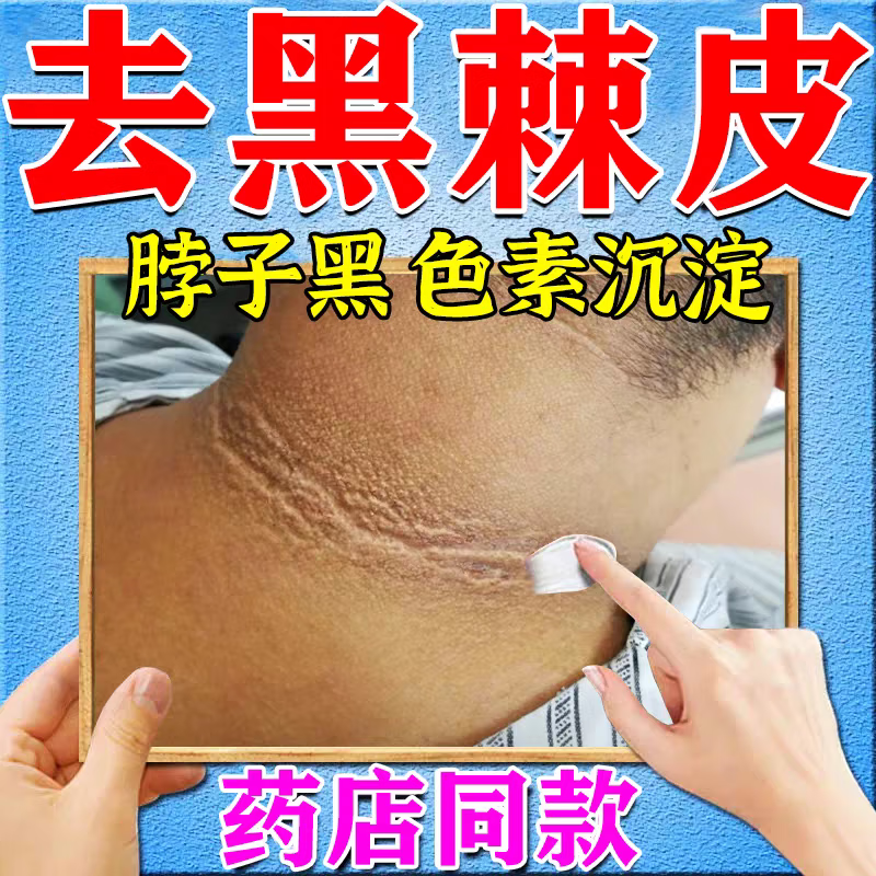百约王黑棘皮病药专用治脖子黑色素沉淀去除药膏胖人儿童草本修护膏