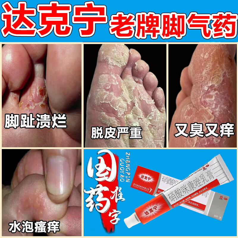 達克寧腳氣藥止癢脫皮爛腳丫真菌感染根藥治止癢 腳趾縫水泡癢潰爛嚴重腳氣藥 硝酸咪康唑乳膏 1盒裝【腳氣藥止癢脫皮爛腳丫真菌感染止癢根藥治】