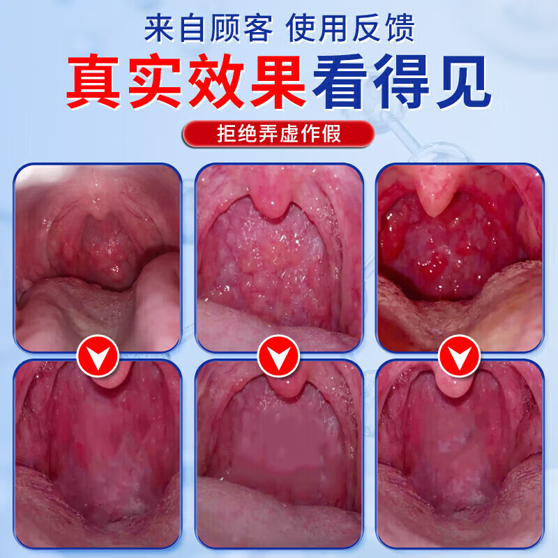 怡美堂北京同仁堂急慢性咽喉炎扁桃体炎咽喉肿痛的辅助治疗咽炎贴嗓子痒 3盒装【实付2盒】急慢性咽炎扁桃体炎
