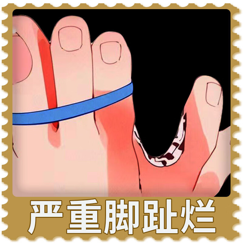圳禾堂脚痒水泡脱皮烂脚丫脚趾缝烂痒脚丫子痒烂脚沙虫脚药止痒抑菌药膏 发五盒【深层巩固装】 京东折扣/优惠券
