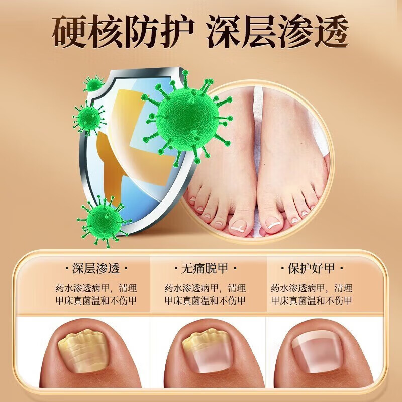 南京同仁堂灰指甲特殊效去除药变空发黄增厚真菌感染亮甲甲沟修复灰甲抑菌液 【见效装】1盒