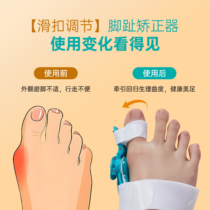 CUYPAS医用拇指外翻矫正器大拇指儿童成人脚趾可调节旋钮分趾固定器 蓝绿色 L【适用于男性39-44码】