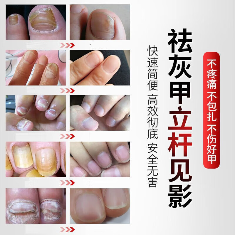 亮甲东京灰指甲专用真菌感染正品 [疗程装]3瓶装