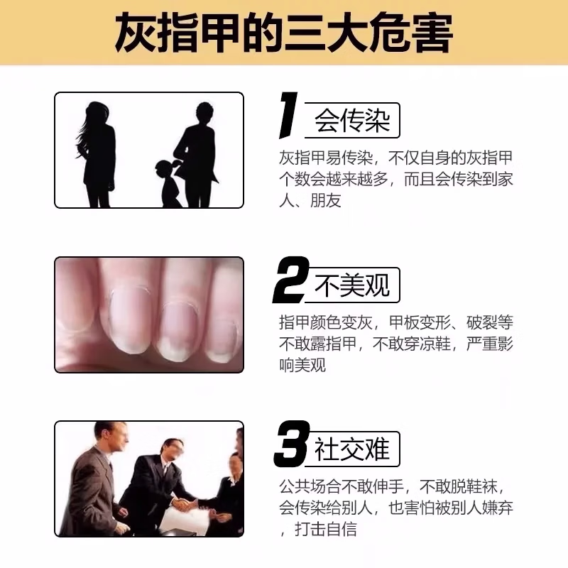 北京同仁堂灰指甲泡脚药包真菌感染甲床分层增厚发黄指甲损伤坏烂中草足浴包 单盒【抑菌专用】建议按周期购买