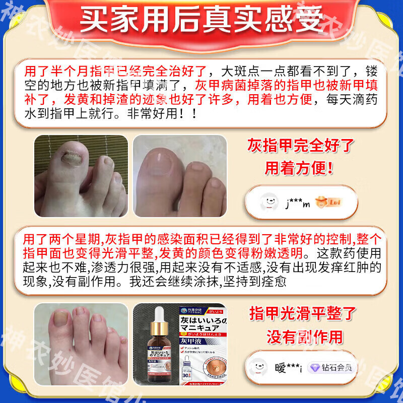 秋雅奈绪灰指甲特傚效药第1名专用指甲真菌感染脱甲坏甲根I治日本进口重度 特效：一盒