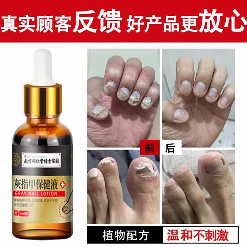 南京同仁堂灰指甲特殊效去除药变空发黄增厚真菌感染亮甲甲沟修复灰甲抑菌液 【见效装】1盒