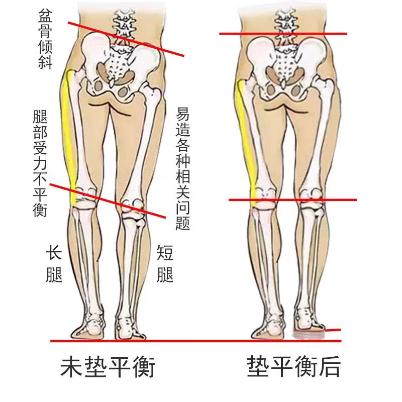 花会优长短腿矫正鞋垫高低脚短脚脊柱侧弯骨盆高低肩调节下肢不等长专用 4层/2cm【送2层】 M号30-38码