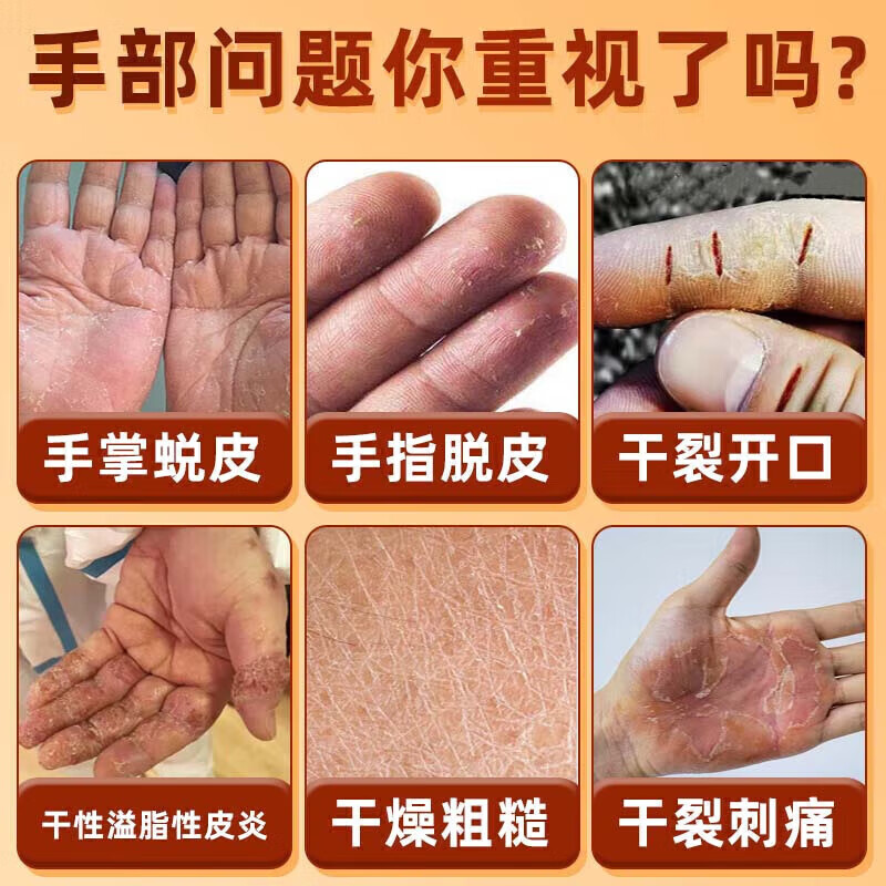御神堂手裂愈合膏手足皮肤干燥皲裂严重度粗糙修复专用防手指开裂口药膏 特效膏【100%断裉】：买3送2
