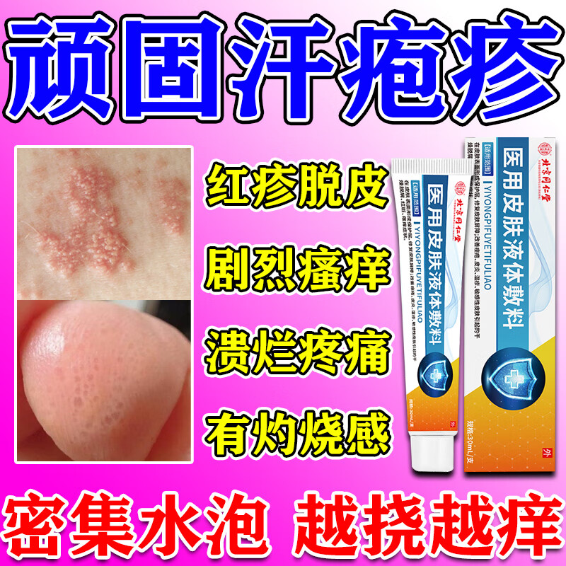 内廷上用汗疱疹抑菌膏手上痒起小水泡药皮炎湿疹皮癣真菌感染止痒脱皮专用 买五送四
