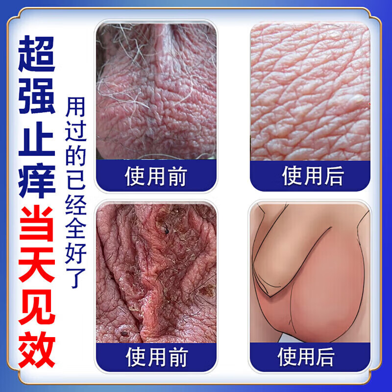 阴囊干燥脱皮瘙痒干裂男人下体私处湿疹止痒私处阴囊痒去潮湿喷剂 私处湿痒特效管用:一盒【乳膏】