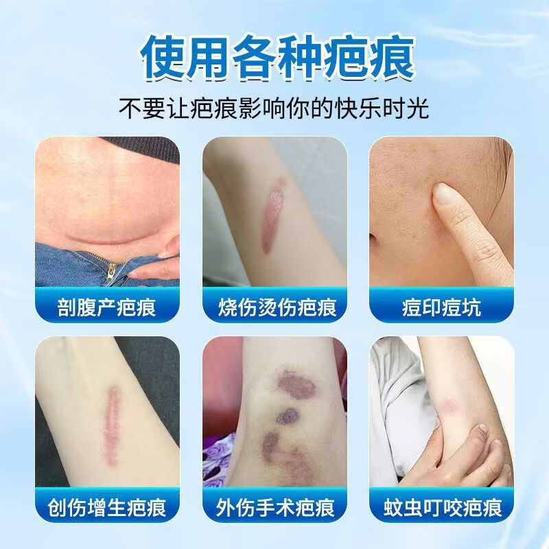 修正医用硅酮疤痕凝胶20克/支手术疤烫伤疤划伤疤增生疤痘疤医疗器械 1支【医用硅酮疤痕凝胶】 20克/支