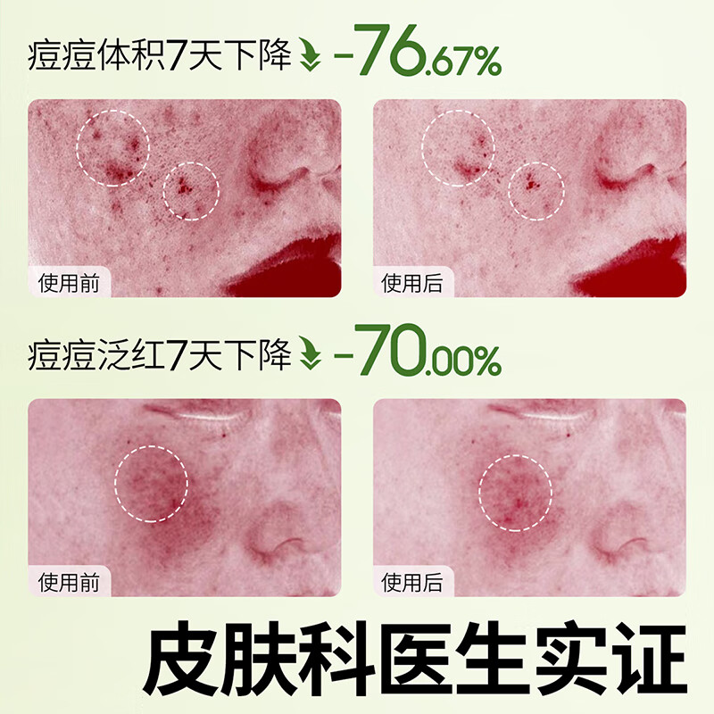 植物妈妈青少年洗面奶12-18岁洗面奶青少年学生专用青春期控油祛痘洗面奶 【控油祛痘】青少年洗面奶100g*1