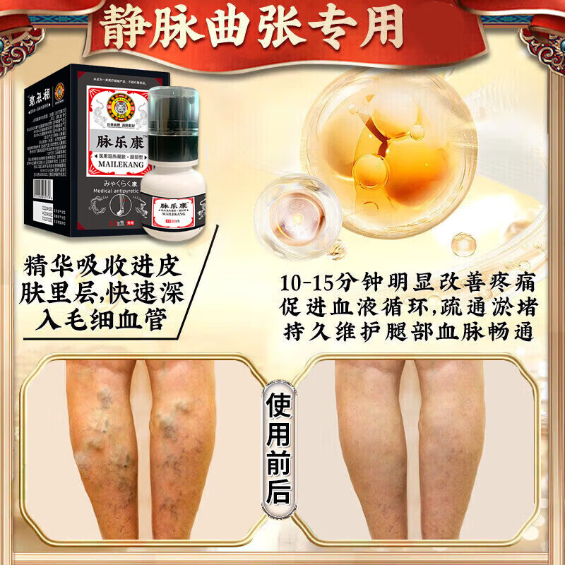 北京协和医学院静脉曲张专用膏药蚯蚓腿疏通血管堵塞进口药冷敷凝胶治疗静脉舒膏 特效1盒【静脉曲张专用】 特效静脉曲张喷雾专用贴的
