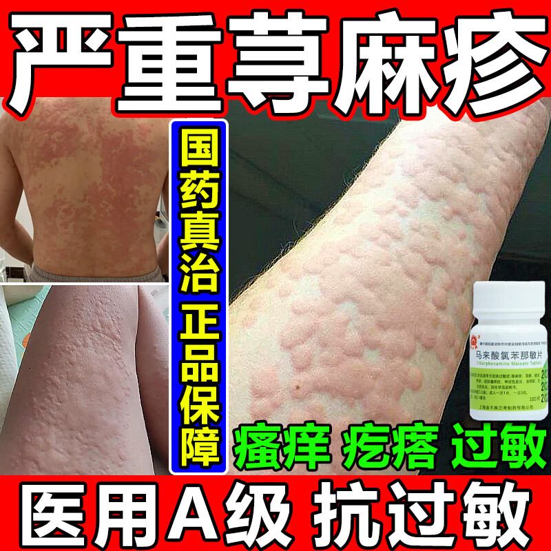 荨麻疹专用药过敏止痒慢性荨麻疹100%主图视觉特效抗过敏药皮肤瘙痒