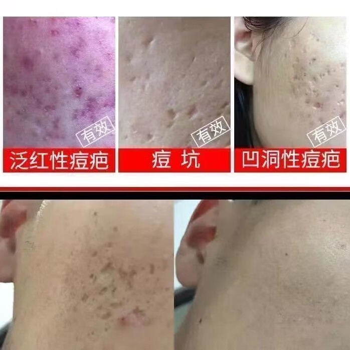同仁堂青少年祛痘膏修复淡化痘印祛痘凝胶淡化痘坑学生凝胶霜男女青草膏 青少年祛痘膏 1支