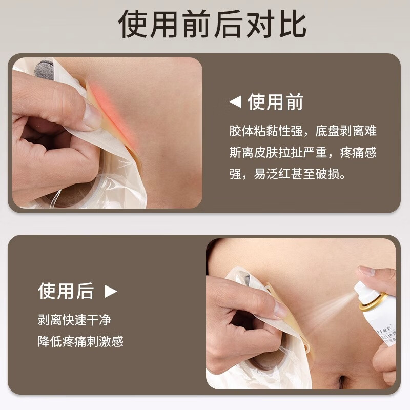 护士同学12020造口皮肤保护剂造口袋黏胶去除剂造口防漏圈造口护理四件套 造口黏胶去除剂12010【65ml月度装】