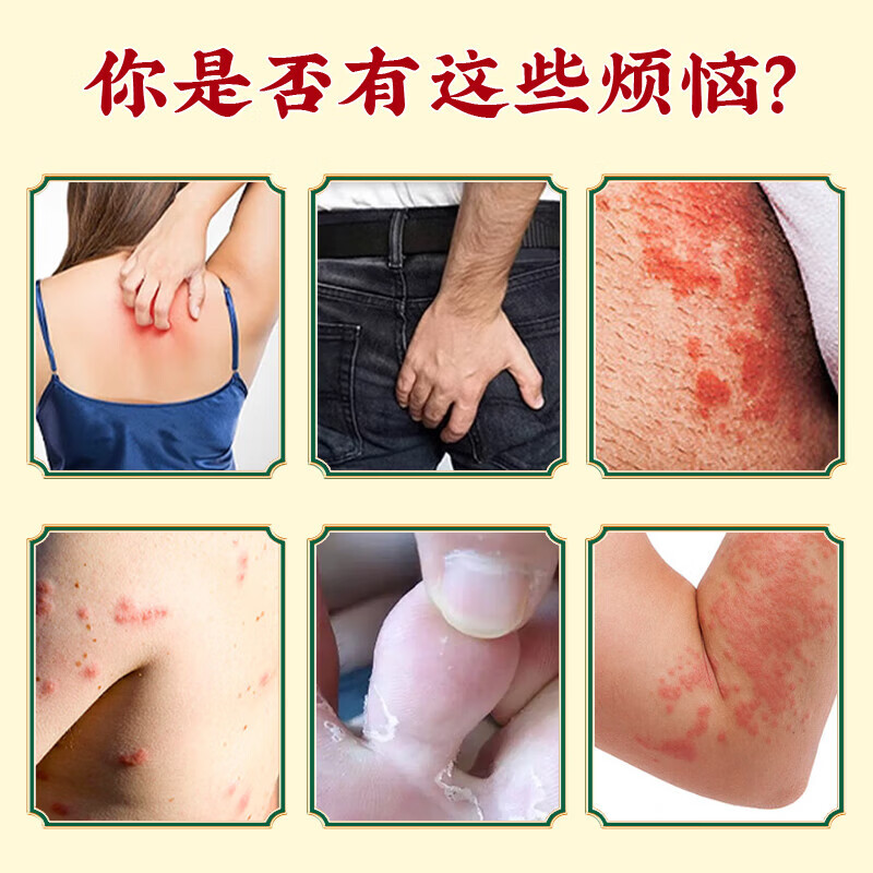 香港大药房有限公司真菌王皮肤瘙痒真菌感染私处抑菌阴囊潮湿大腿内侧肛门男女通用  1瓶【严重真菌感染】不划算