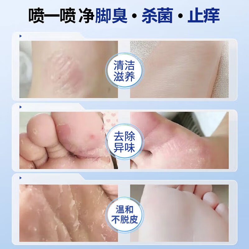 步爽灵抑菌液皮肤瘙痒植物精华护理液脚臭痒脚汗脚喷雾清爽舒缓喷剂成人 植物精华抑菌液60ML*1盒