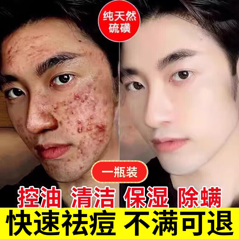 LQTMSZ硫磺洗面奶控油祛痘除螨虫去黑头粉刺收缩毛孔男女专用旗舰店正品 一瓶装 京东折扣/优惠券